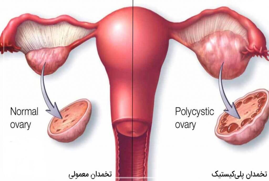 علل ابتلا به سندرم تخمدان پلی کیستیک چیست؟